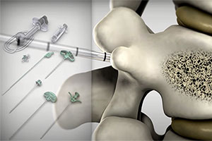 Graphic of kyphoplasty treatment